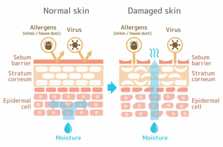 Ilustrasi kerusakan skin barrier